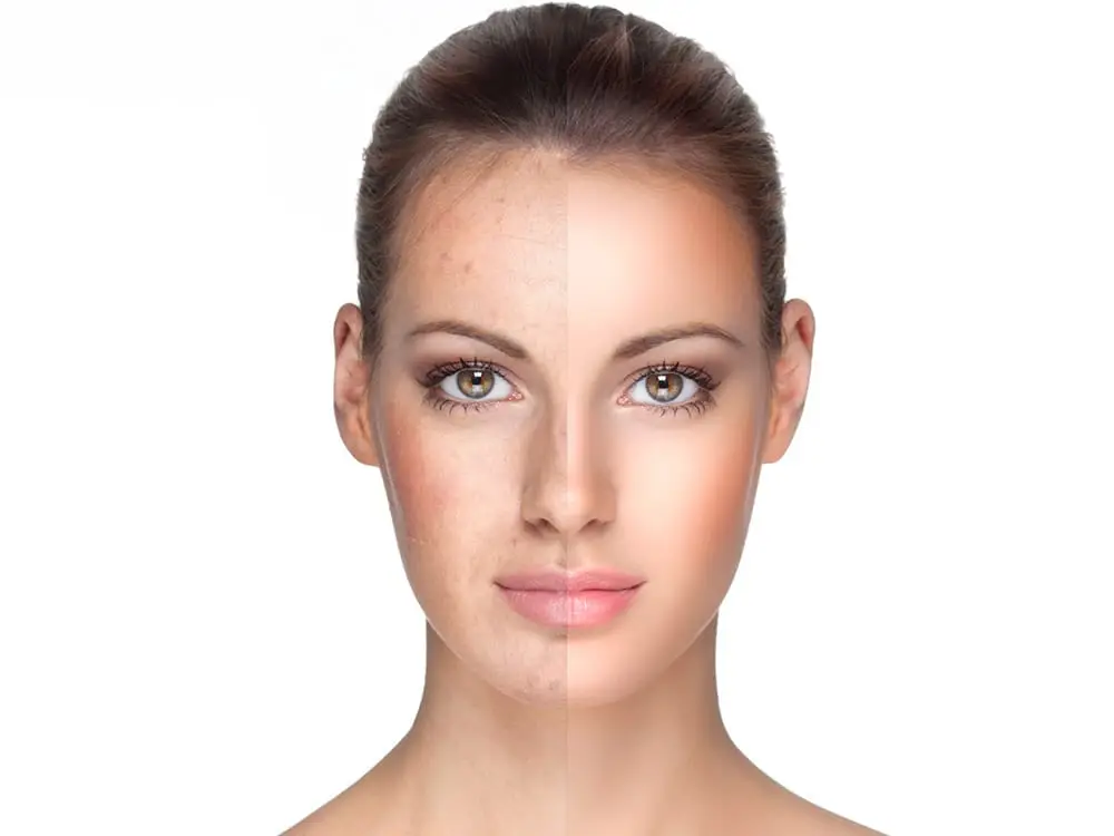 Glutathione IV Drip Dubai