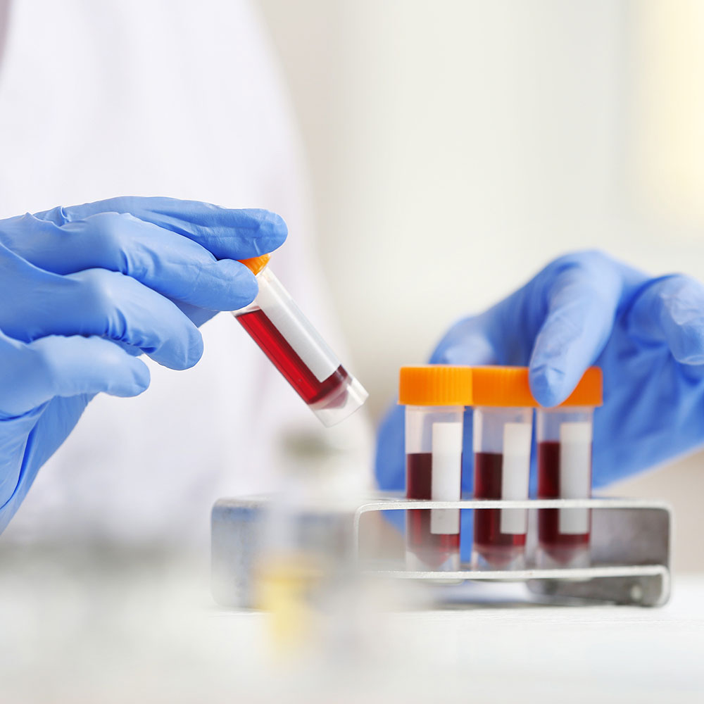 Lab Test At Home Blood Analysis in Dubai