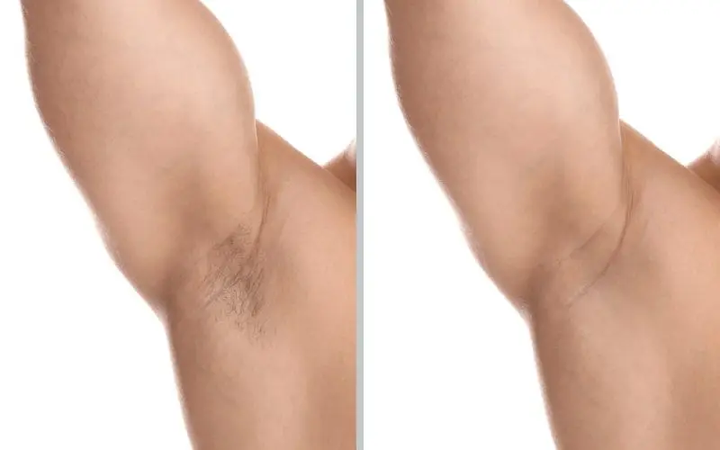 Under arm Laser hair removal dubai